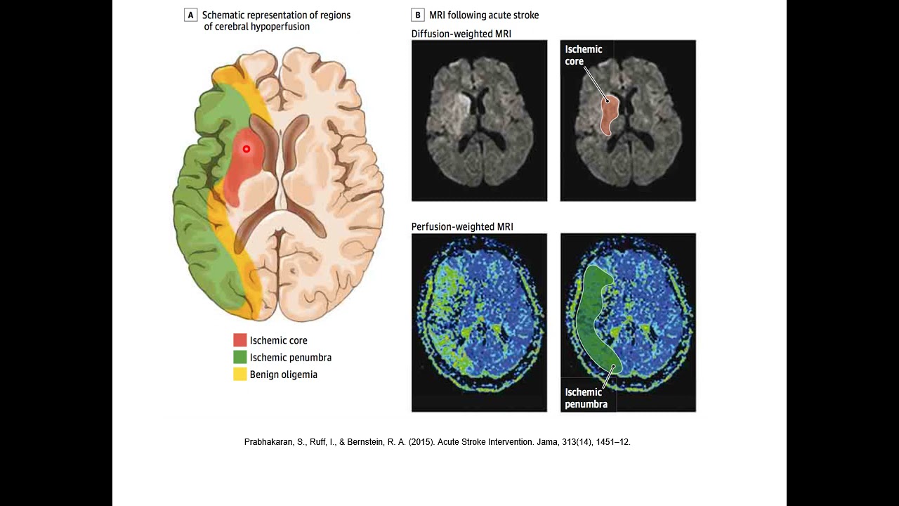 Enfermedad Cerebrovascular