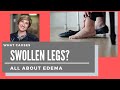 EDEMA - What causes swollen legs and feet?