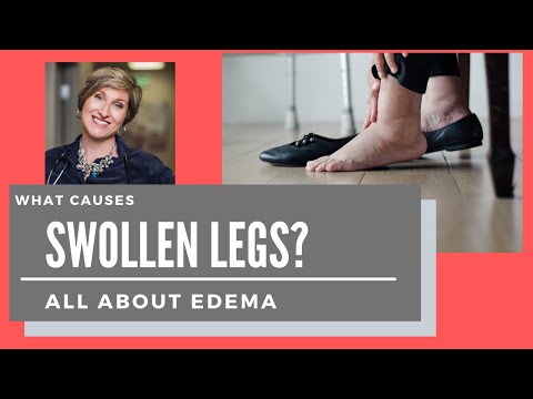 Video: Foot Edema - Causes, Symptoms And Treatment Of Foot Edema