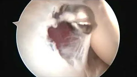 Como é feito a cirurgia de epicondilite lateral?