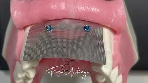 Horizontal GBR with Titanium Mesh and Tenting Screws