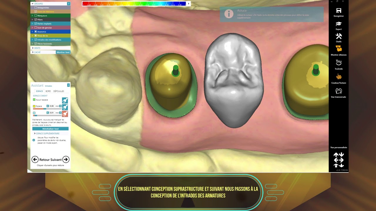 [EXOCAD] Piliers + bridge Transvissé