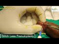 Frenulum Repair Procedure without stitches for painful sex,Early Discharge(PE)Treatment by Dr.Kuber