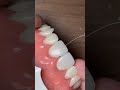 Diastema Closure Composite Instagram Live 14 April 2020 part 2