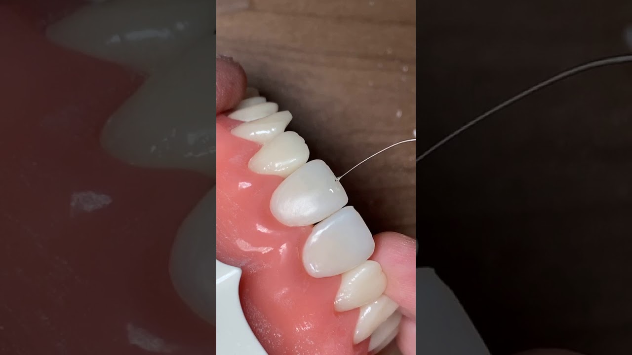 Diastema Closure Composite Instagram Live 14 April 2020 part 2