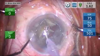 The Best Way To Do Cataract Surgery #11, Double Chop, Cross Chop, 3  Dense Lens