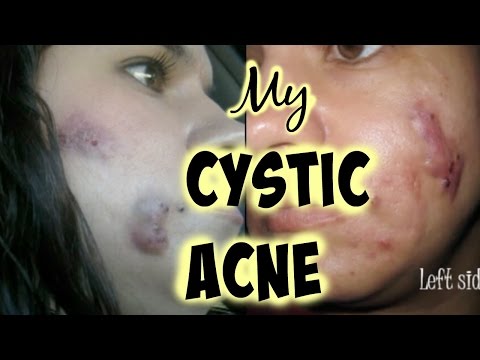 My  Cystic Acne - - Mamiposa