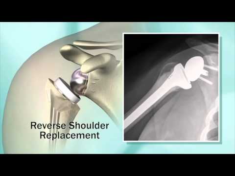Reemplazo de Hombro y Prótesis Invertida en pacientes con dolor de hombro - Dr. Sanchez-Sotelo