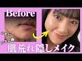 ニキビ・ニキビ跡・肌荒れを徹底的に隠すメイクを紹介 !!