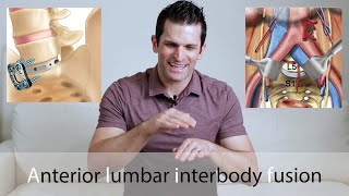 ALIF Surgery // Anterior lumbar interbody fusion