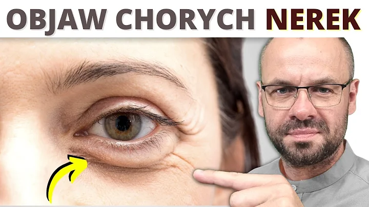 13 oznak, że NERKI wołają o pomoc.