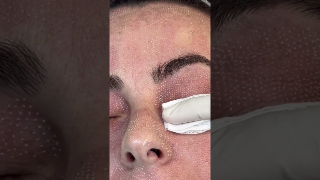 Laser FractionalCO2 Eyelids tightening #olimpiacarmen #co2laser #fractionalco2laser #laserexperts