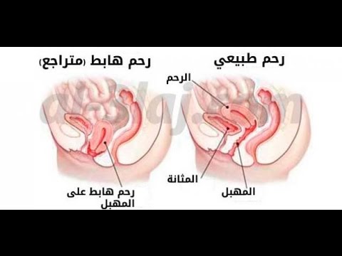 اعراض هبوط الرحم
