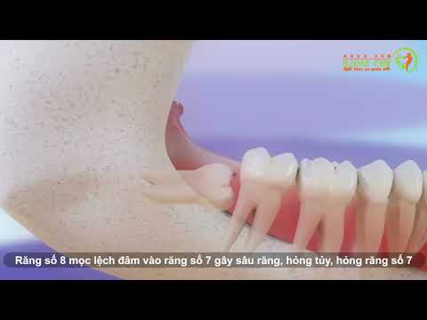 Video Tại sao phải nhổ răng 8 - nhổ răng khôn? - youtube