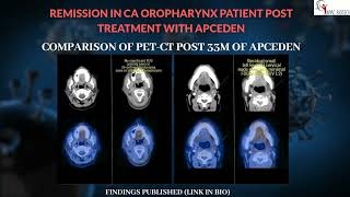 COMPLETE REMISSION OF OROPHARYNX CANCER WITH DENDRITIC CELL THERAPY (APCEDEN)