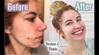 RODAN & FIELDS UNBLEMISH REGIMEN: 12 WK RESULTS! | Emily Inman