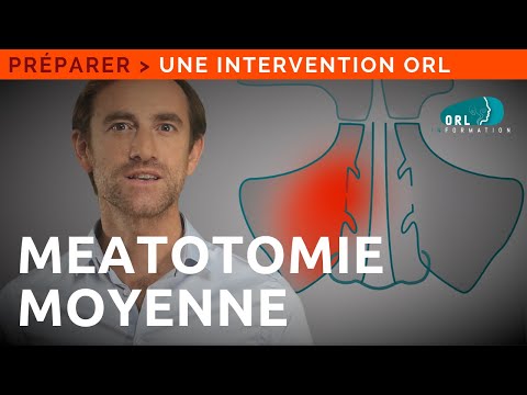 Information Patient | Chirurgie du nez (ouverture des sinus maxillaires)