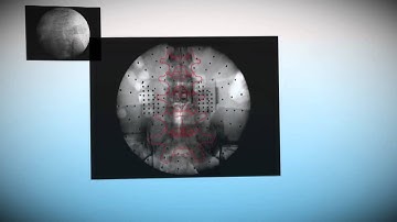 Mazor Robotics   How It Works Step 3