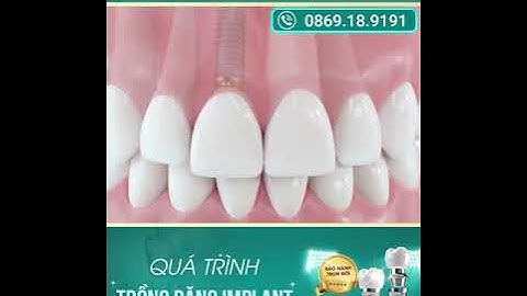 QUÁ TRÌNH TRỒNG RĂNG IMPLANT CHUẨN TẠI VINDENTAL LUXURY