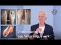 Hallux valgus behandeling van voetentraining werkt minder pijn en rechtere teen