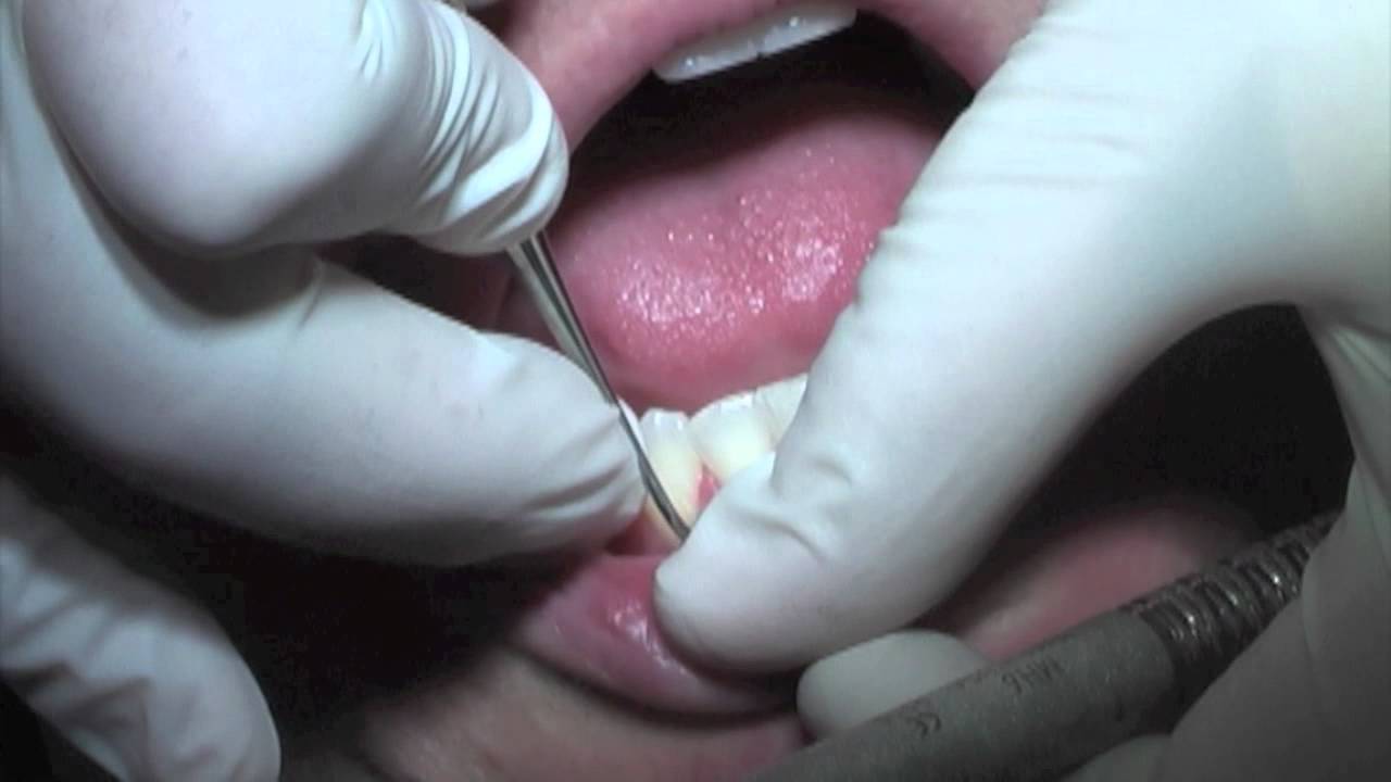 WSU Dental Hygiene - Anterior Instrumentation