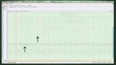 Dense array EEG recorded novel feature of electrographic seizure