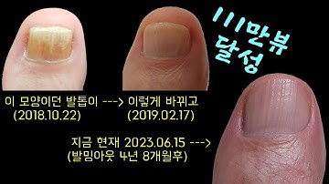 20년동안 저를 괴롭히던 녀석을 보내버렸어요.. 발톱무좀 안녕 ^,*