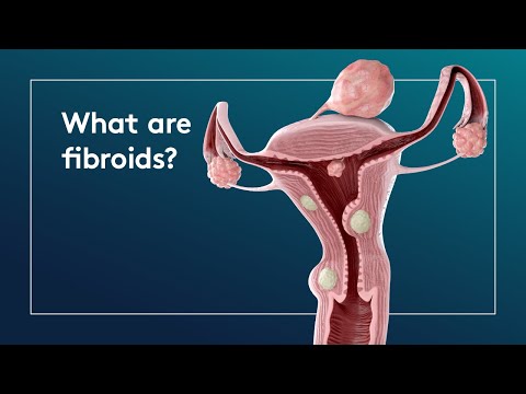 Vídeo: Fibromioma Da Mama, Fibroide Nodular