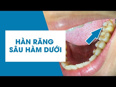 Video: Làm thế nào để chăm sóc răng trám: 14 bước (có hình ảnh)