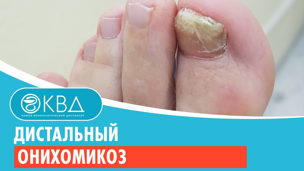 😐 Дистальный онихомикоз. Клинический случай №198 - YouTube