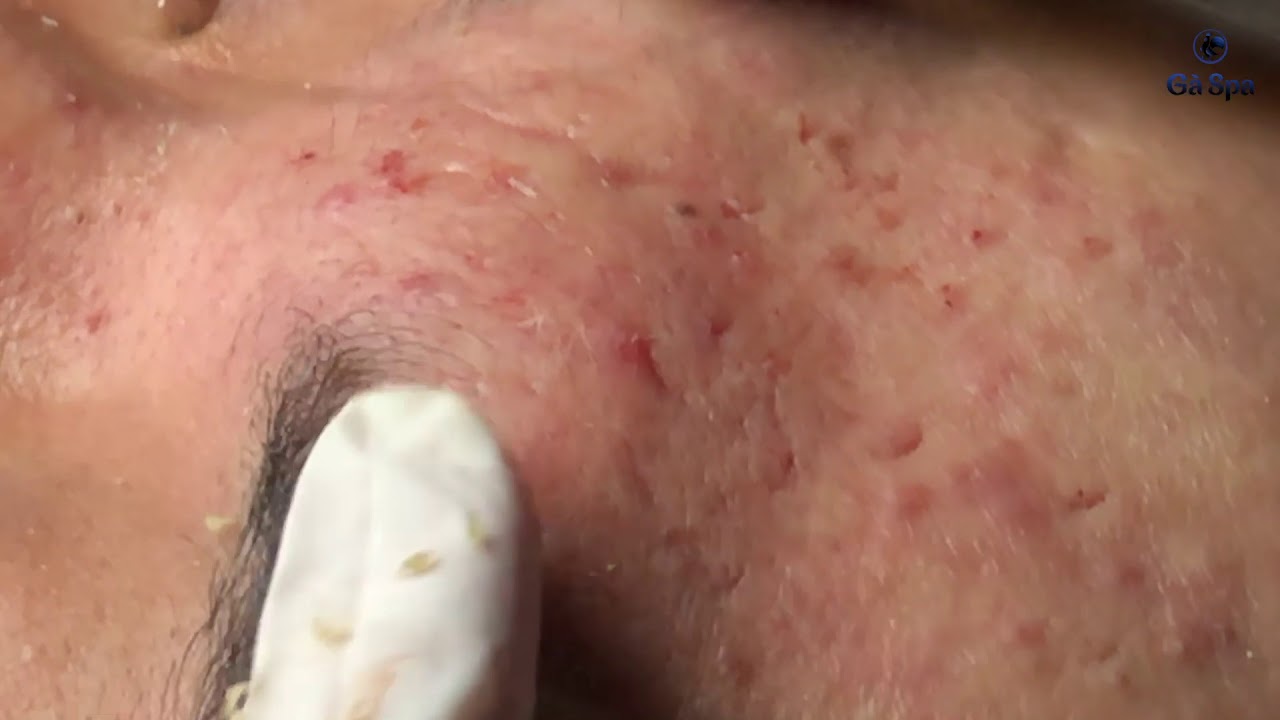 SIGNATURE SERVICE: Acnes Treatment (Ver.3)