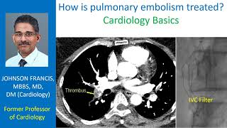 How is pulmonary embolism treated? Cardiology Basics