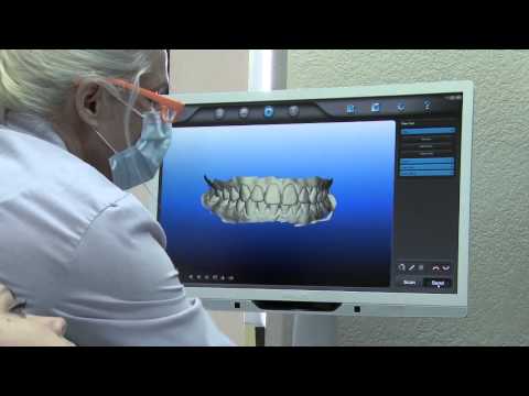 iTero Orthodontic Scan Demo 2013