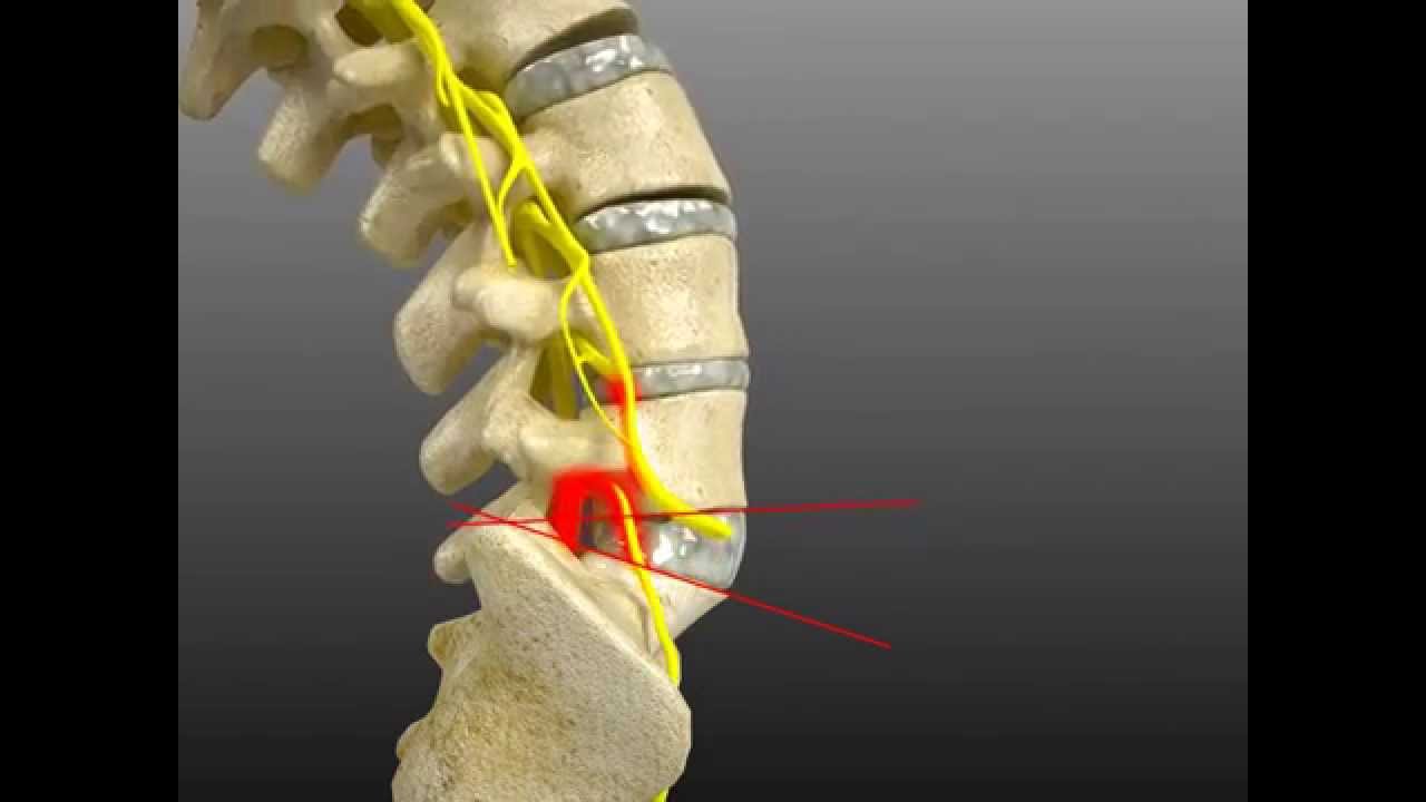 Spinal Adjustment Treatment for L4/L5 Fixation Causing Hyper Mobile L5