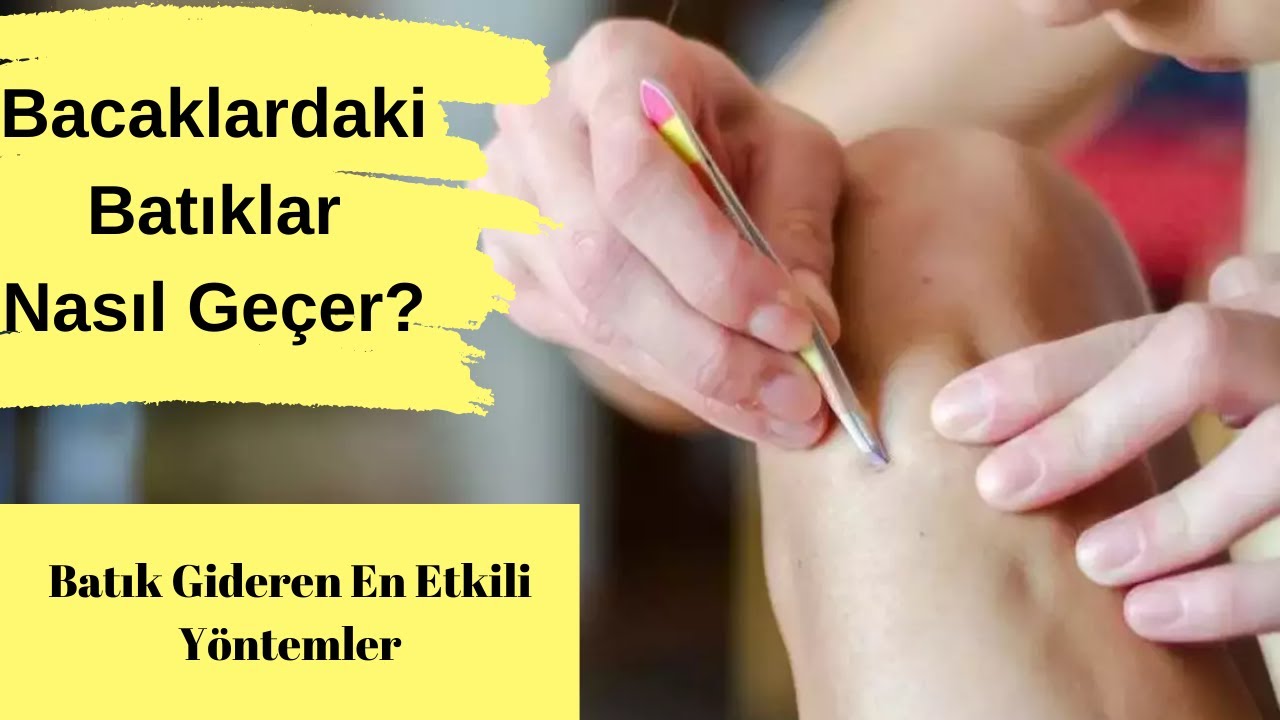 Bacaklardaki Batıklar Nasıl Geçer? En Etkili Yöntemler! 💆‍♀️✨