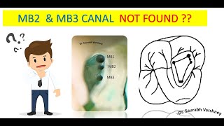 Locate MB2 & MB3 canals easily