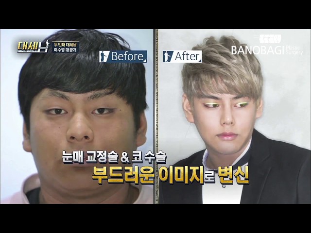 [바노바기] "나는 바노바기에서 멋있어졌다."_ 윤곽수술/지방흡입수술 후기 '남자성형'