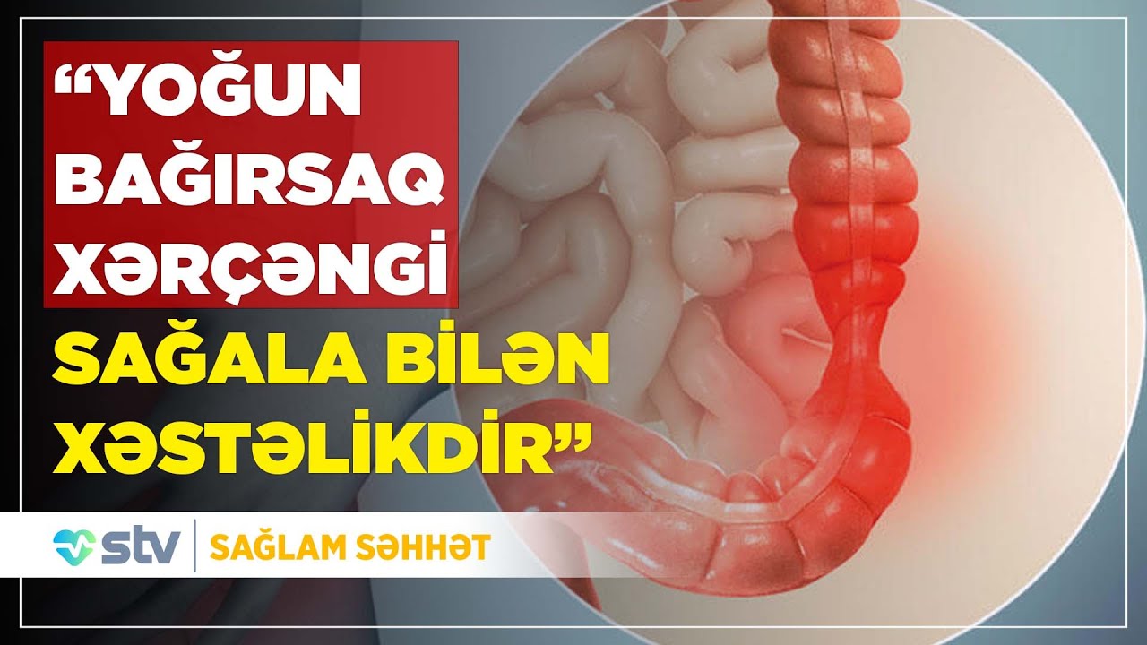 “YOĞUN BAĞIRSAQ XƏRÇƏNGİ SAĞALA BİLƏN XƏSTƏLİKDİR”