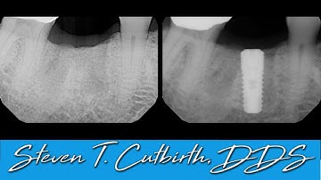 Implant Placement Following PRF Socket Preservation - Dental Minute with Steven T. Cutbirth, DDS