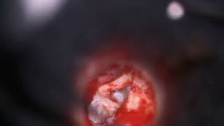 Revision Stapedotomy with cartilage graft