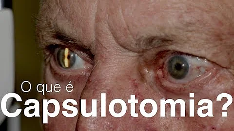 Como é feita a capsulotomia?