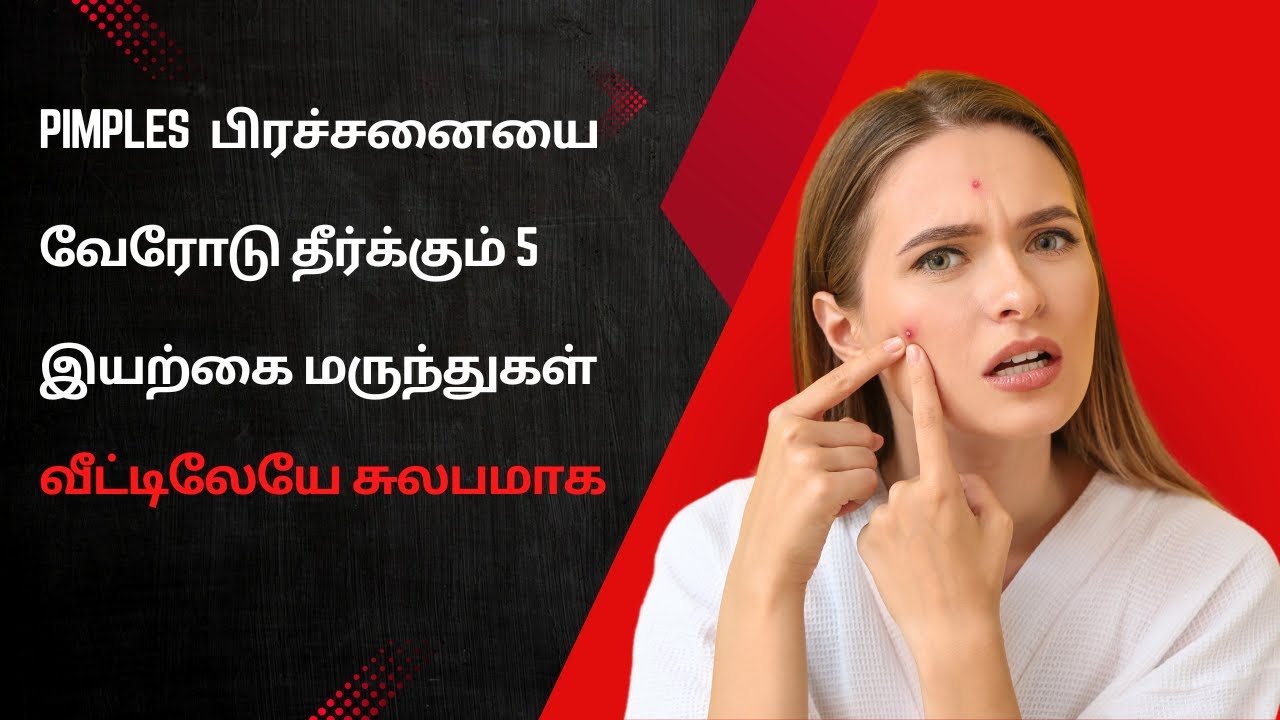 How to Remove Pimples Naturally and Permanently | 5 Best Home Remedies  