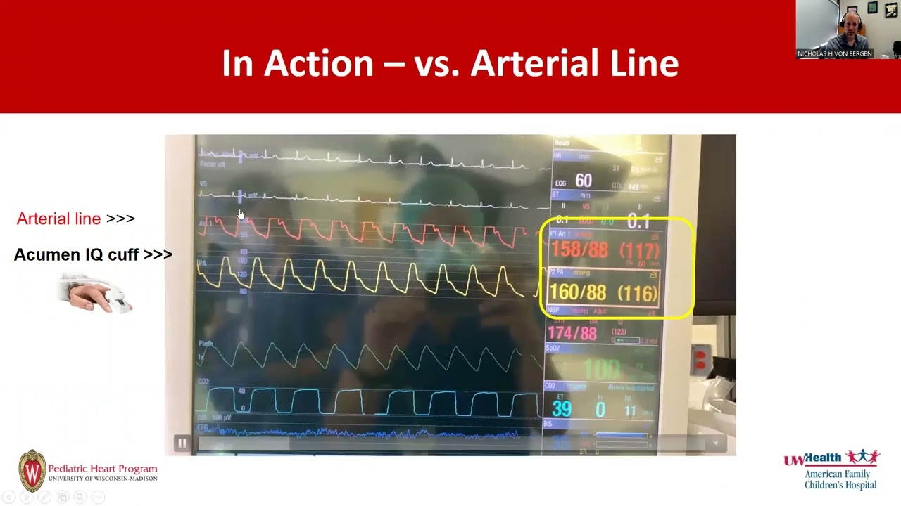 Non-Invasive Blood-Pressure Monitoring for the Electrophysiology Lab.