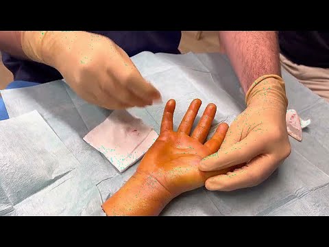 Vidéo: Comment réparer la brachydactylie ?