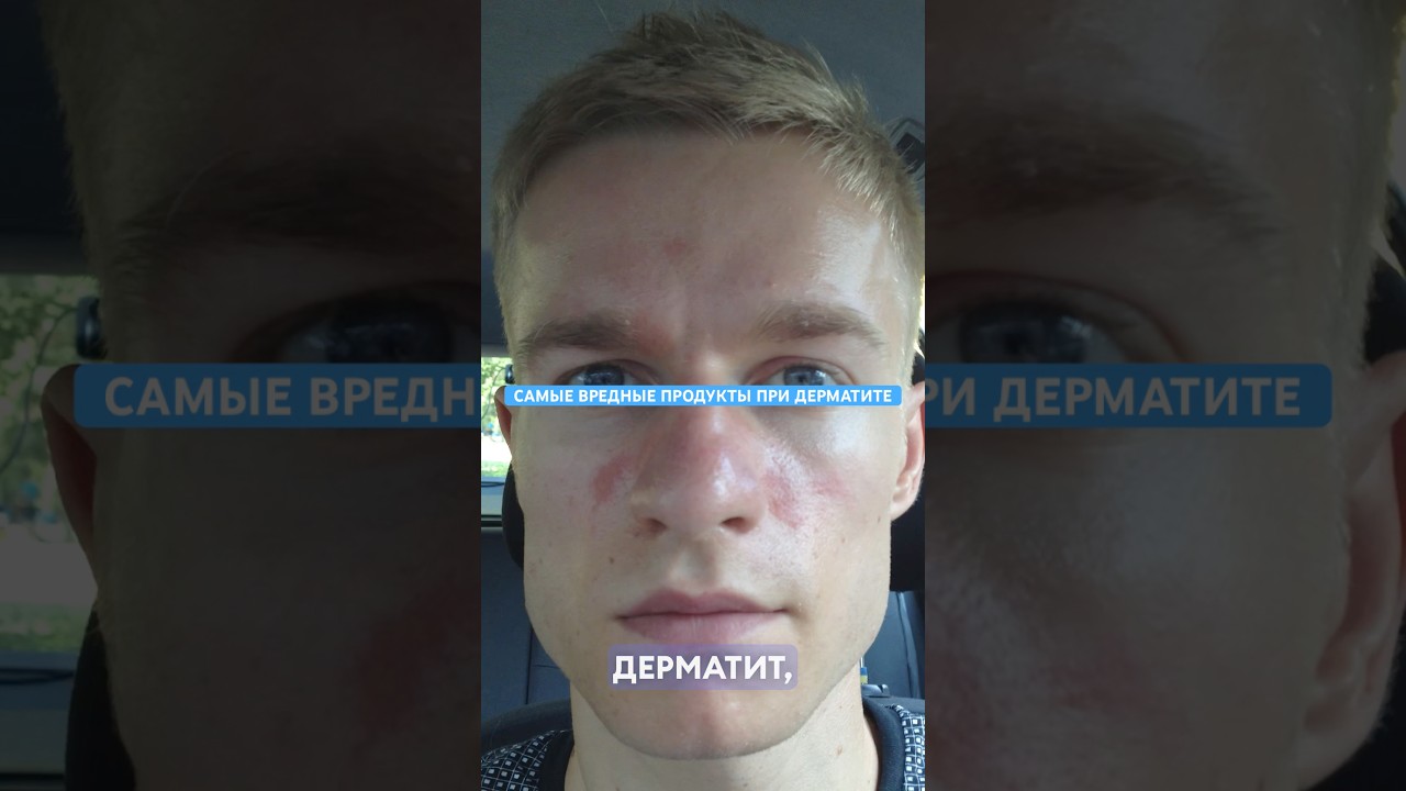 ПРАВДА ПРО ДИЕТУ ПРИ СЕБОРЕЙНОМ ДЕРМАТИТА. Какие продукты исключить при дерматите? #себорея