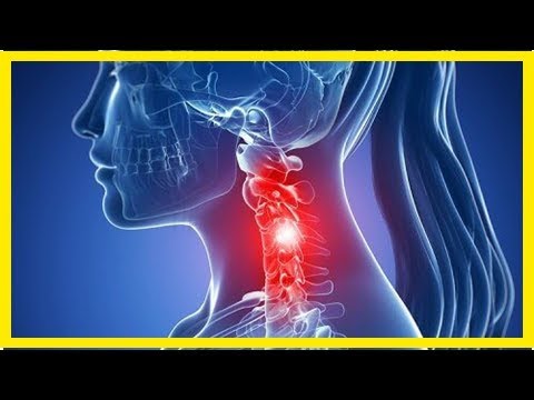Video: Zervikale Spondylose: Ursachen, Symptome, Behandlungen Zu Hause Und Mehr