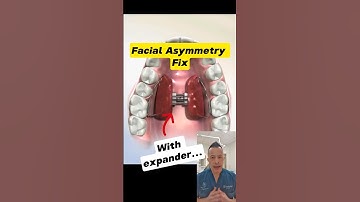 Fixing Facial Asymmetry with a Palate Expander: Here