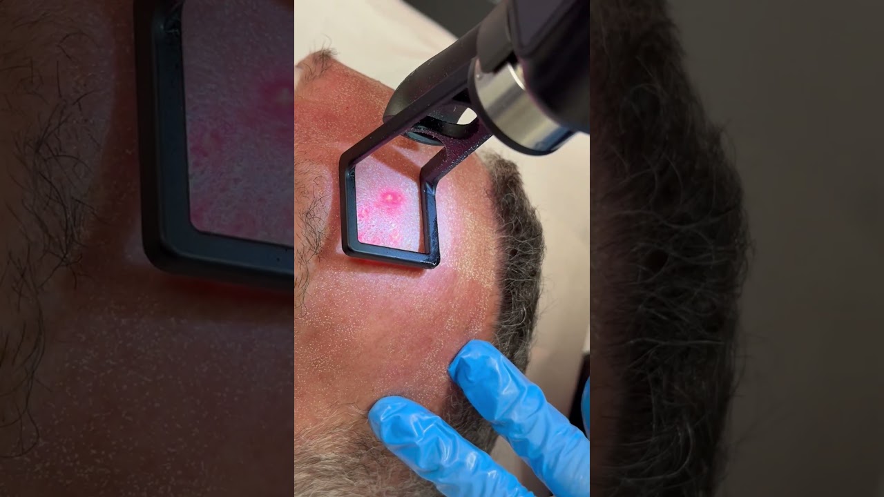 Co2 laser Treatment