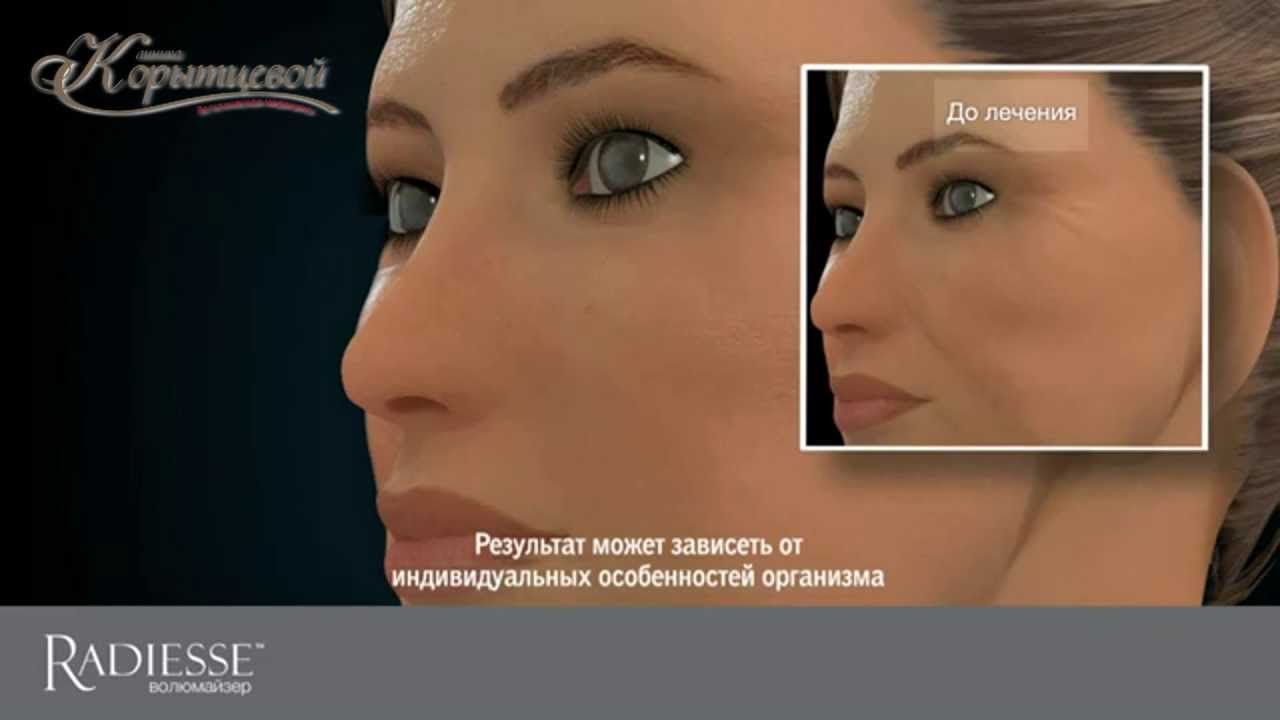Клиника Корытцевой - Объемное моделирование лица препаратом «Radiess»