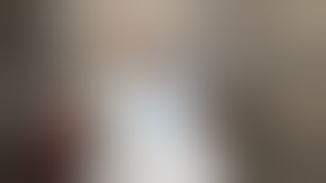 Microvascular Decompression Surgery Classical Trigeminal Neuralgia Dr Sekula Neurosurgeon 7-20-2021